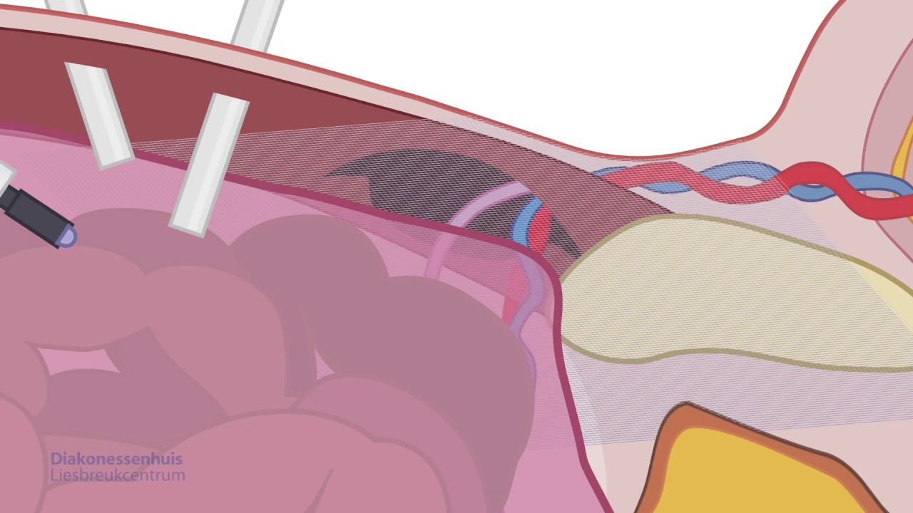 Animatiefilm over een liesbreukoperatie