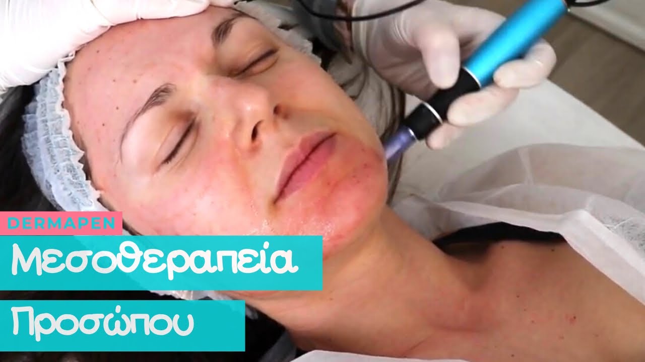 Μεσοθεραπεία προσώπου / Dermapen ( Μη ενέσιμη !!!! ) 
Η εμπειρία μου !!!
