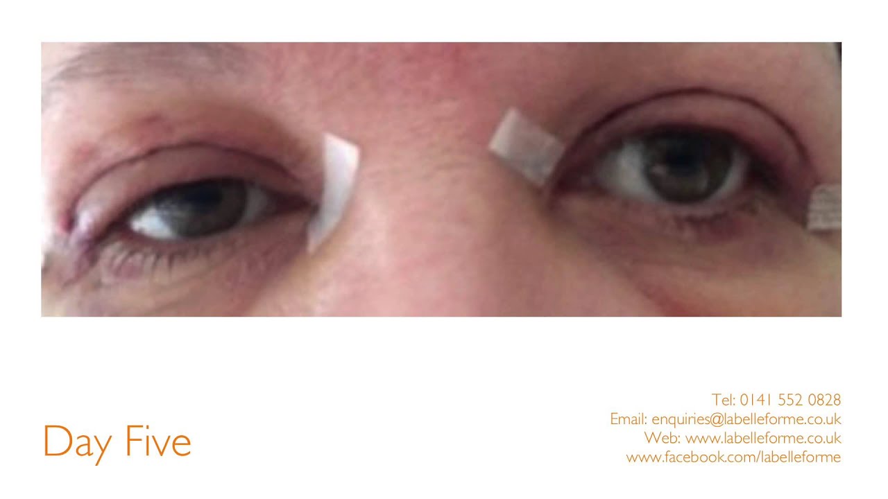Eyelid Surgery at La Belle Forme
