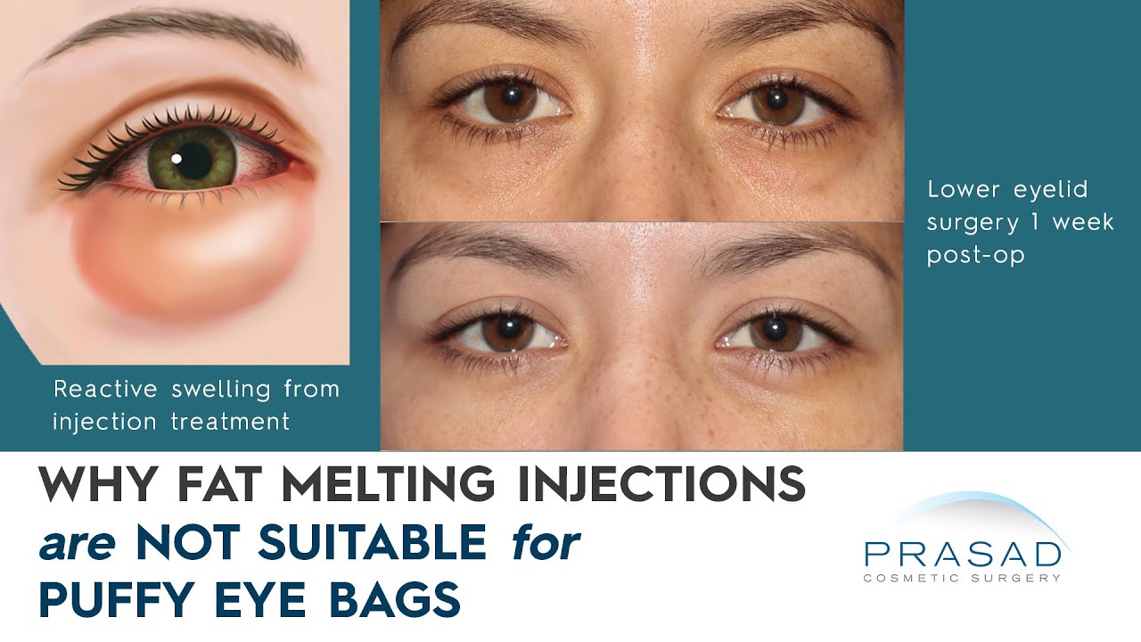 Why Fat Dissolving Injections are Not Advised for Treating Under Eye Bags