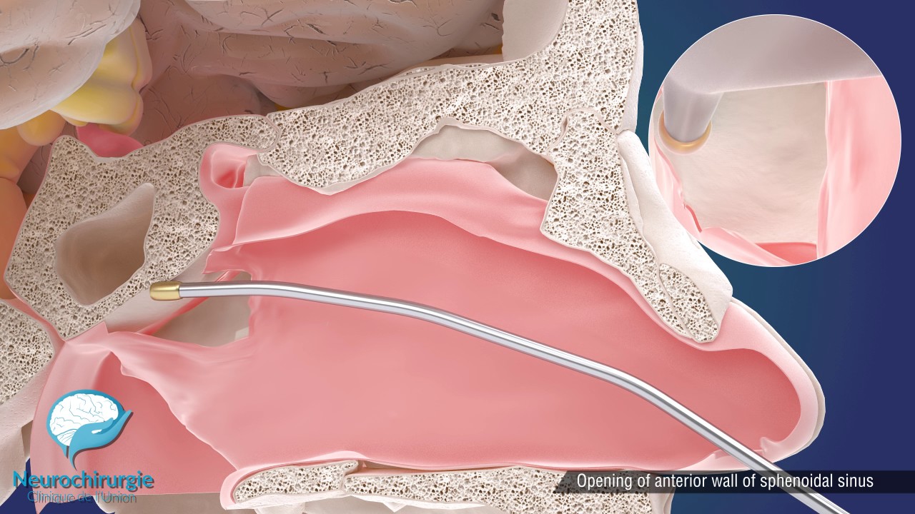 Endoscopic Pituitary Surgery