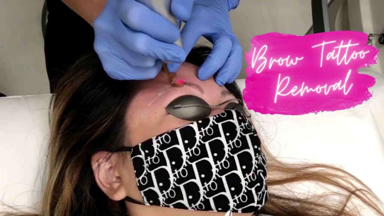 Getting Laser Tattoo Removal on My Eyebrows!