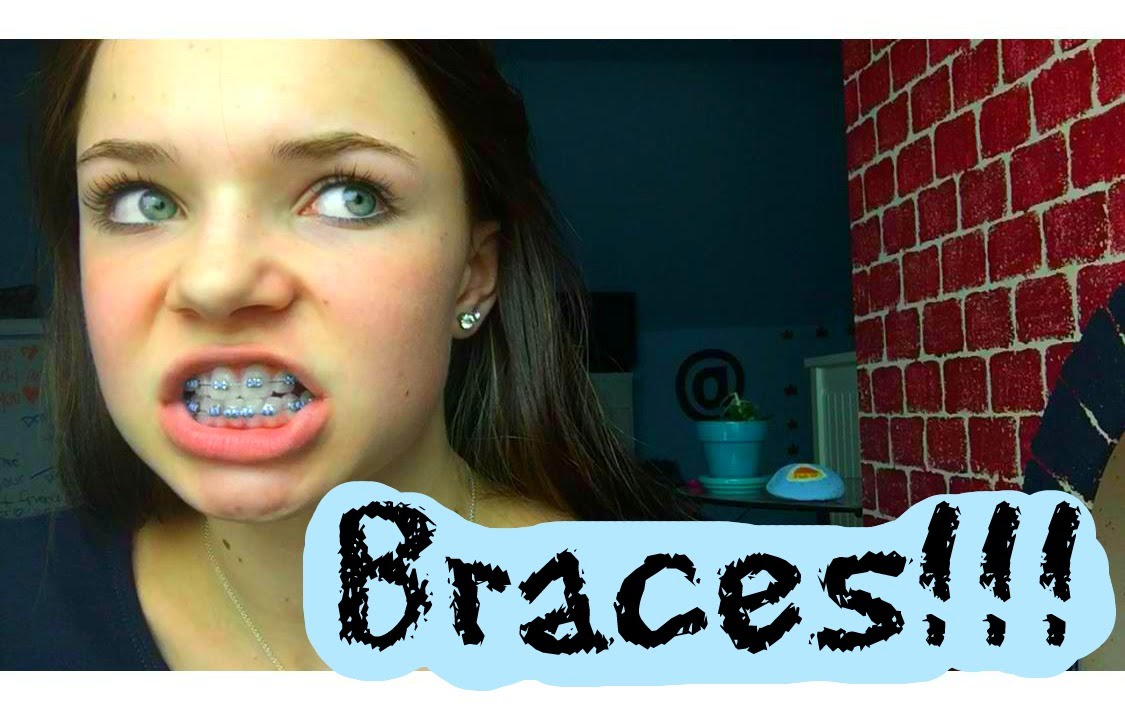 Getting Braces Experience!