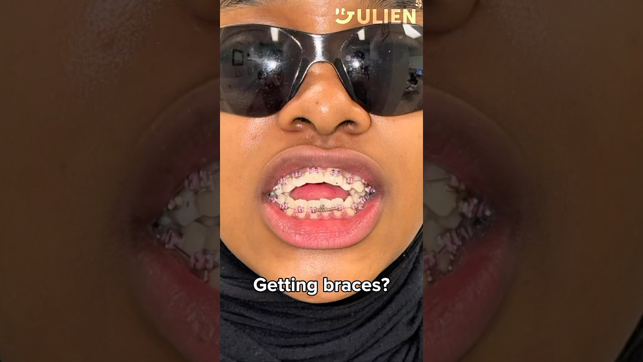 You Must Watch This Before Braces #fyp