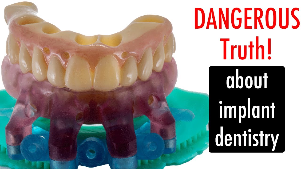 BEWARE of Stackable implant Guides!