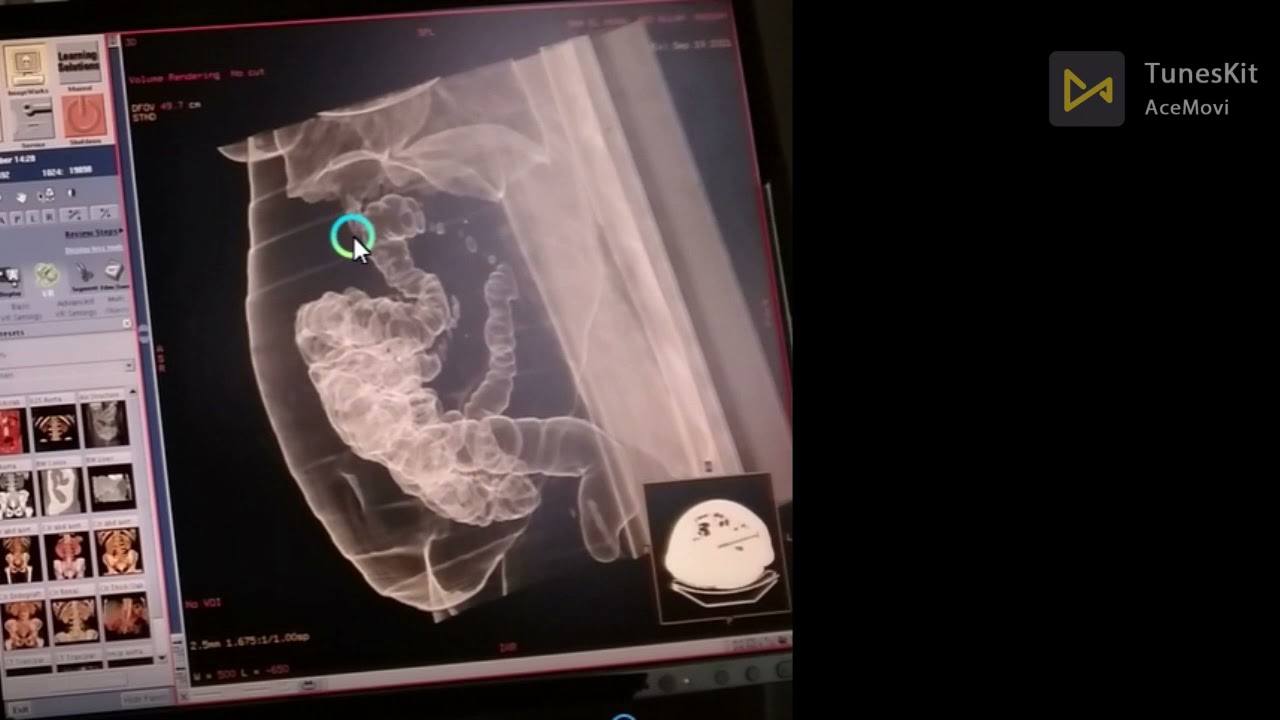 ct colonoscopy part 2 scanning    ازاي اعمل فحص منظار التخيلي للقولون بالاشعه المقطعيه