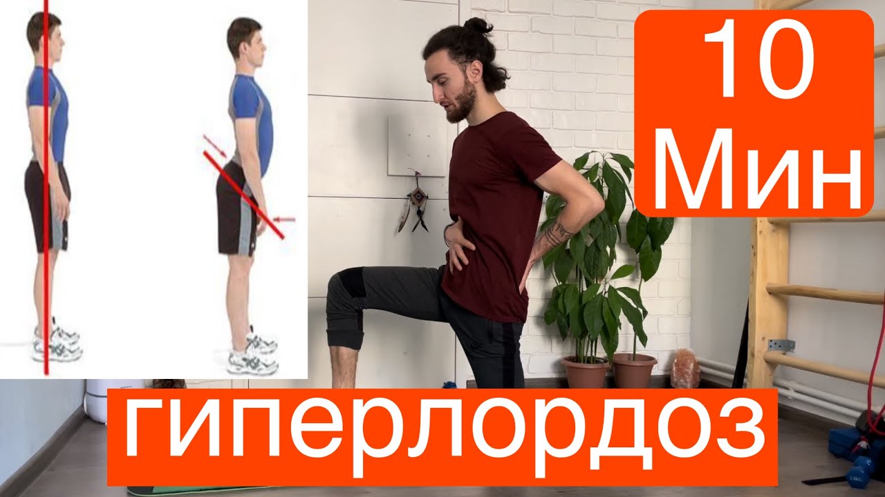Как исправить гиперлордоз | 5 упражнений при гиперлордозе