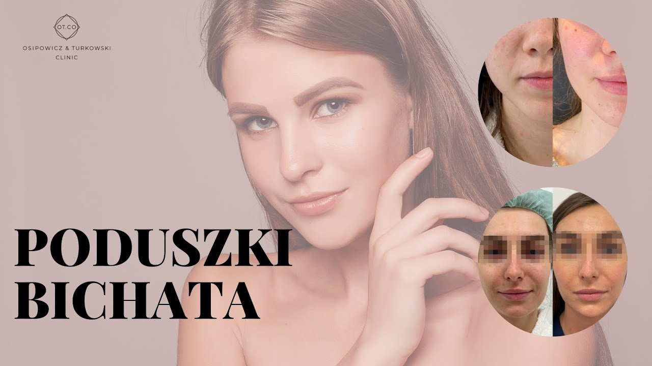 Poduszki Bichata - Usuwanie ich, efekty przed i po zabiegu - OT.CO Clinic