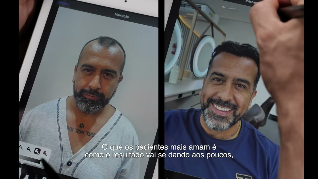 Clínica Oásis - Experiência em Transplante Capilar