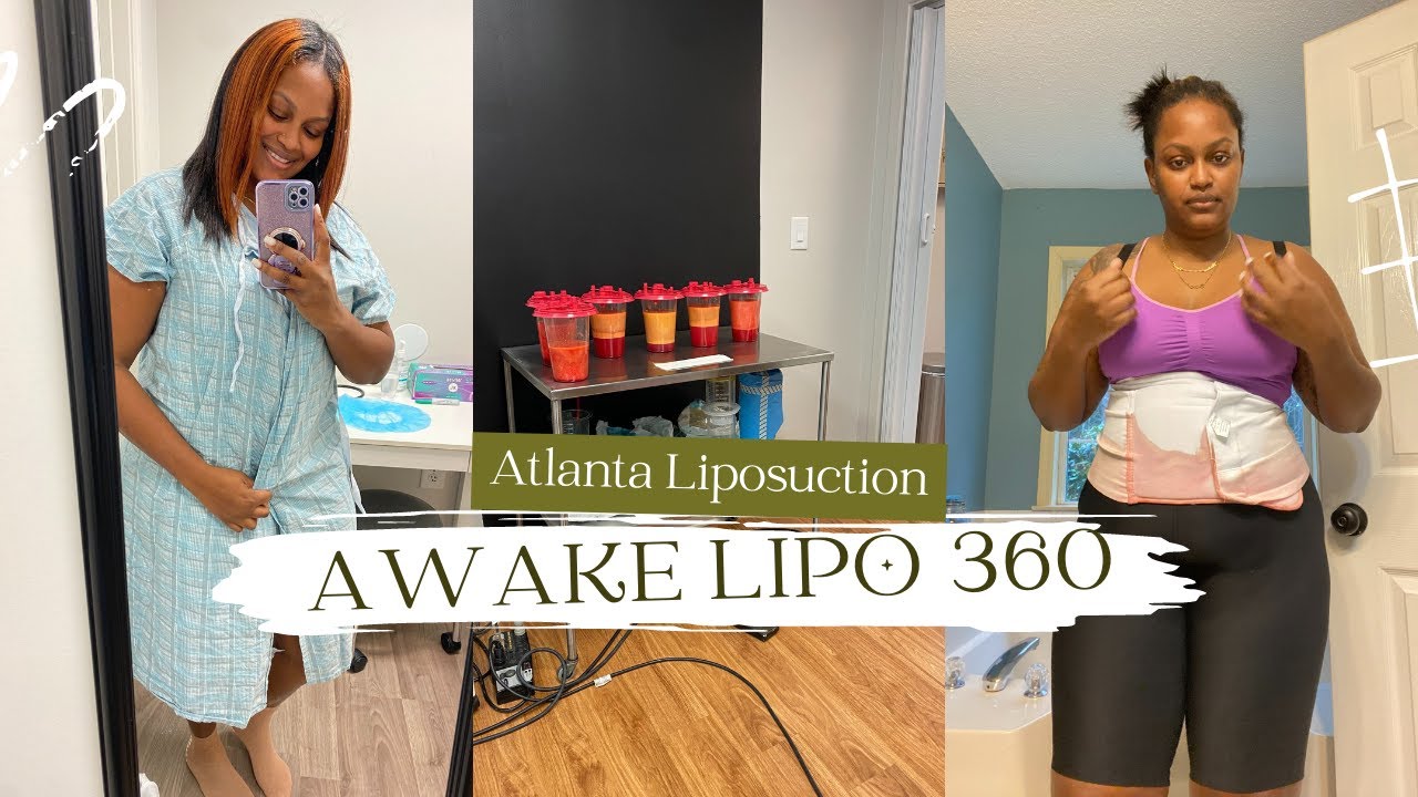 Awake Liposuction 360 plus Bra Rolls