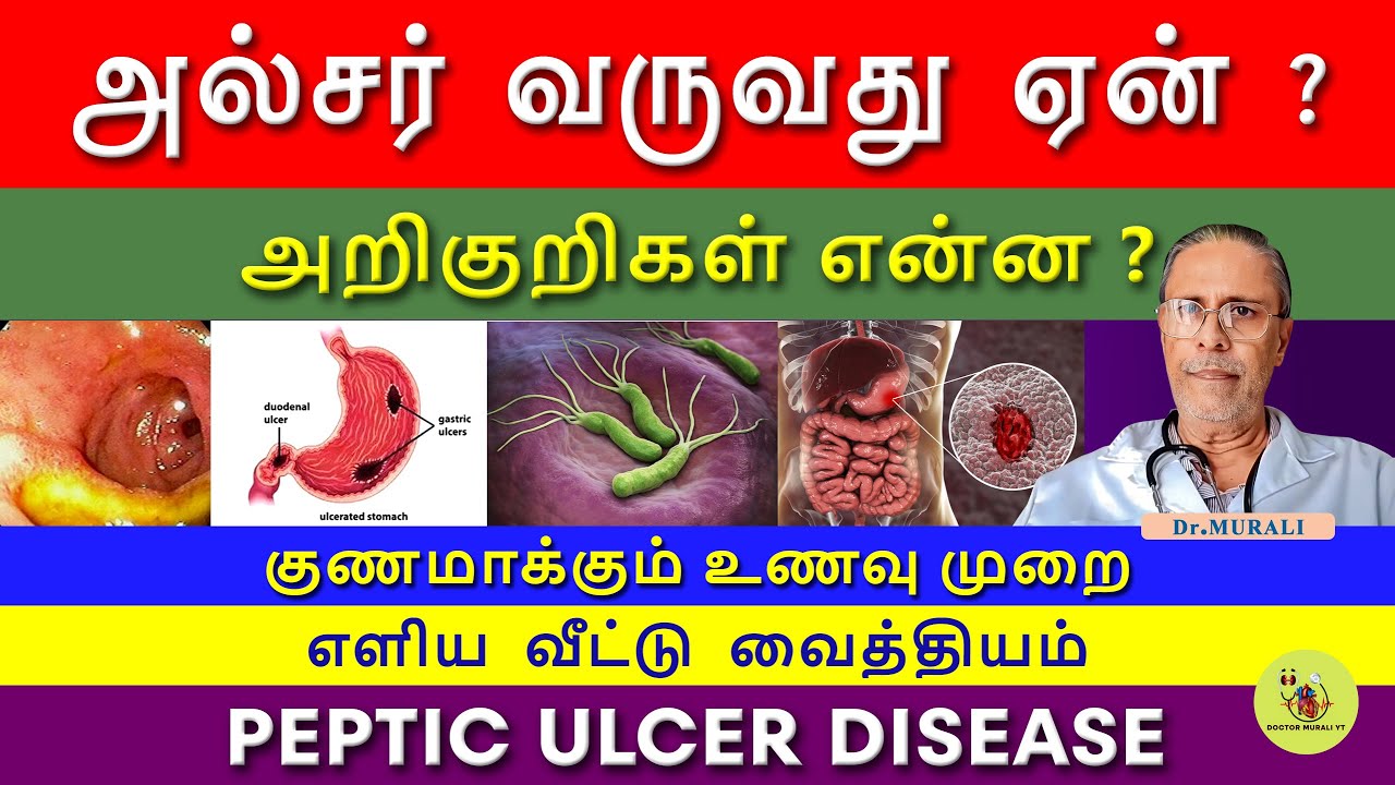 PEPTIC ULCER - SYMPTOMS, CAUSES AND TREATMENT IN TAMIL. FOODS TO CURE ULCER. வயிற்றுப்புண்