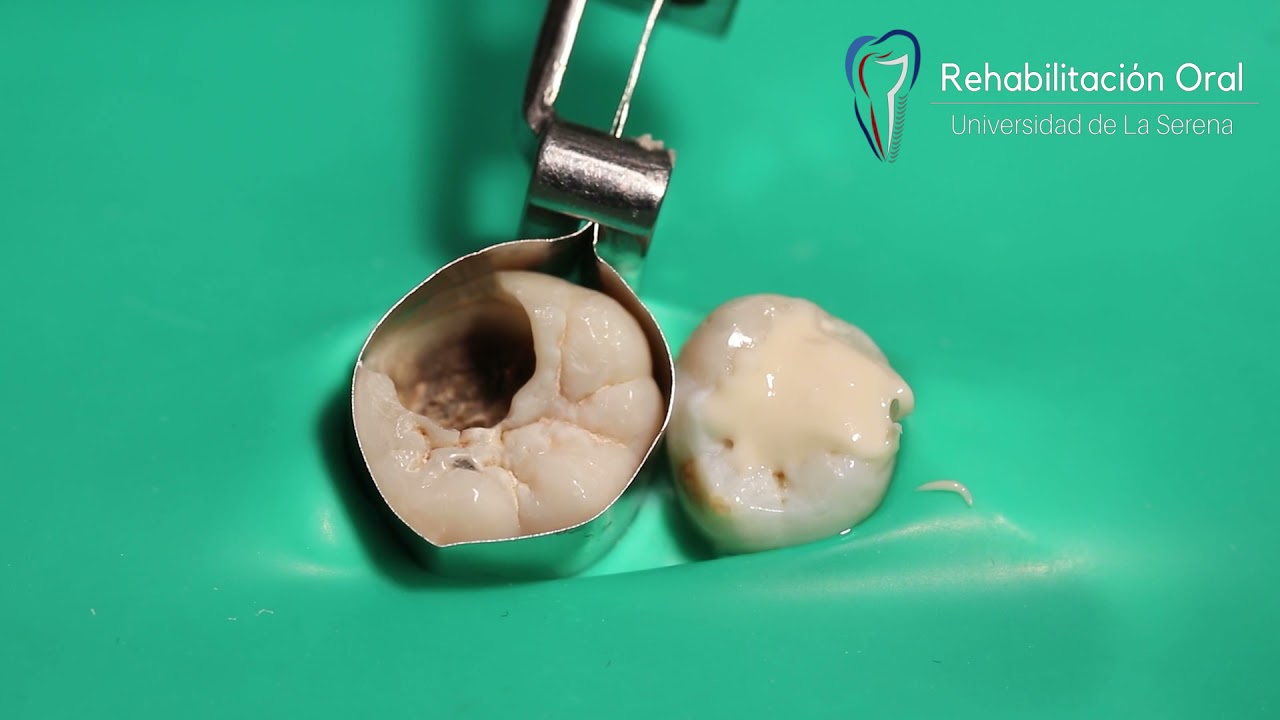 Restauración temporal con Vidrio ionómero (Ketac Molar)
