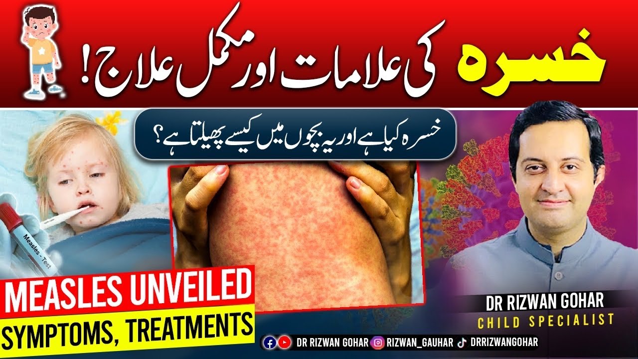 Measles: Understanding Symptoms and Top Treatments #measles #treatment #khasra
