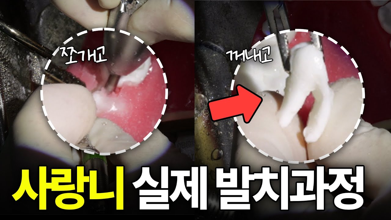 매복사랑니 발치과정