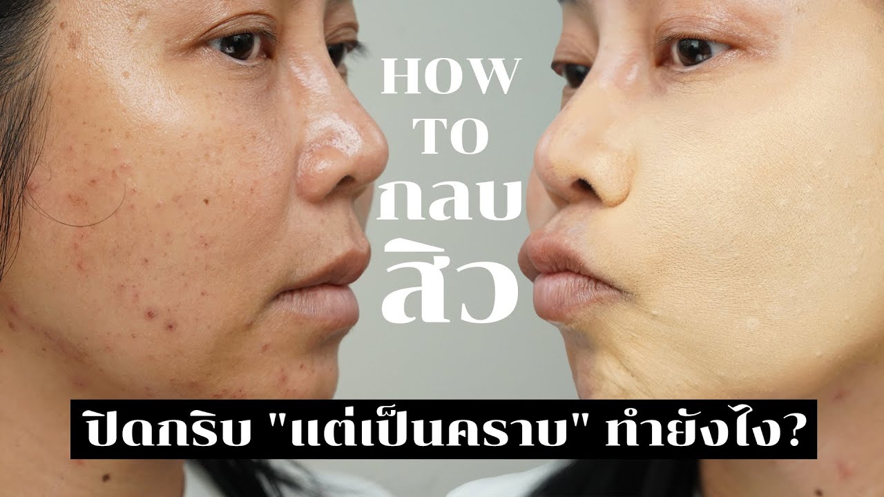 แต่งหน้ากลบสิว ทำยังไงไม่เป็นคราบ? | BEAUTY MOUTHSY