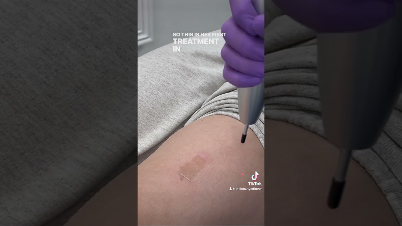 Birthmark removal using laser