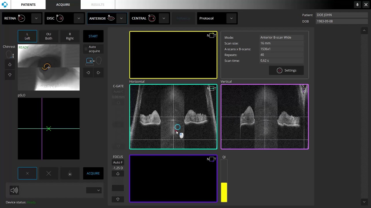 13 Anterior Wide B scan 2 angles