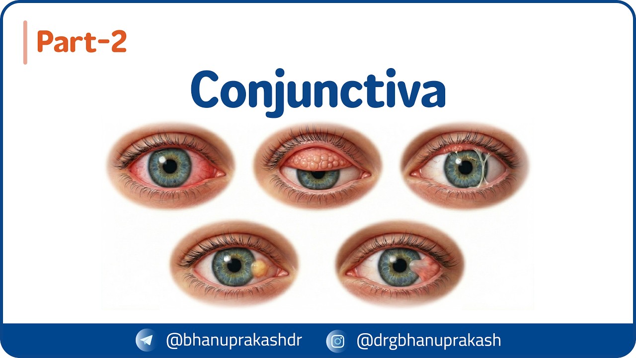 18. Конъюнктива 👁️ Конъюнктивит, трахома, весенний катар, пингвекула и птеригиум (Часть - 2)