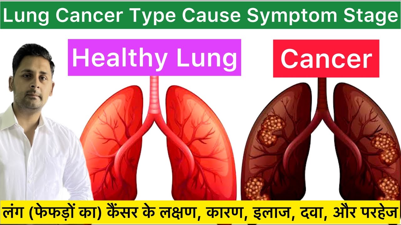 Lung Cancer | Lung Cancer Cause Symptoms Diagnosis Treatment Hindi | What is Lung Cancer,Lung Tumour