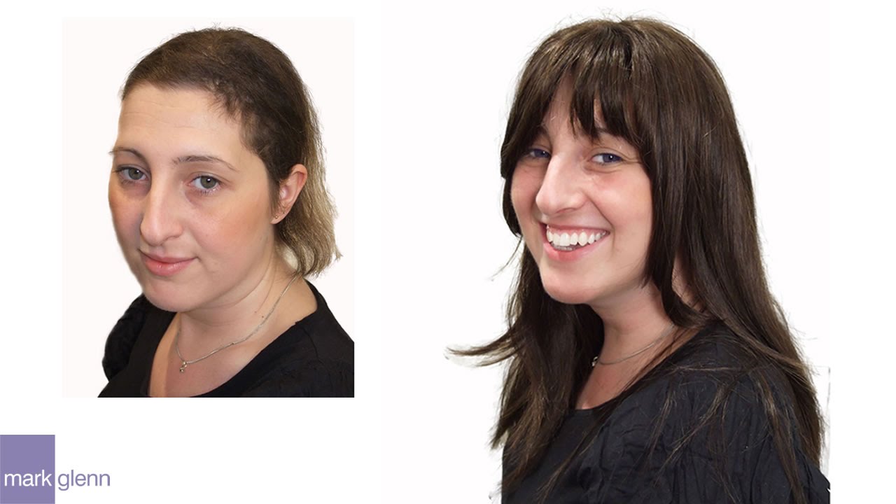 Chemotherapy Hair Loss - Kinsey System - Mark Glenn Hair Enhancement, London