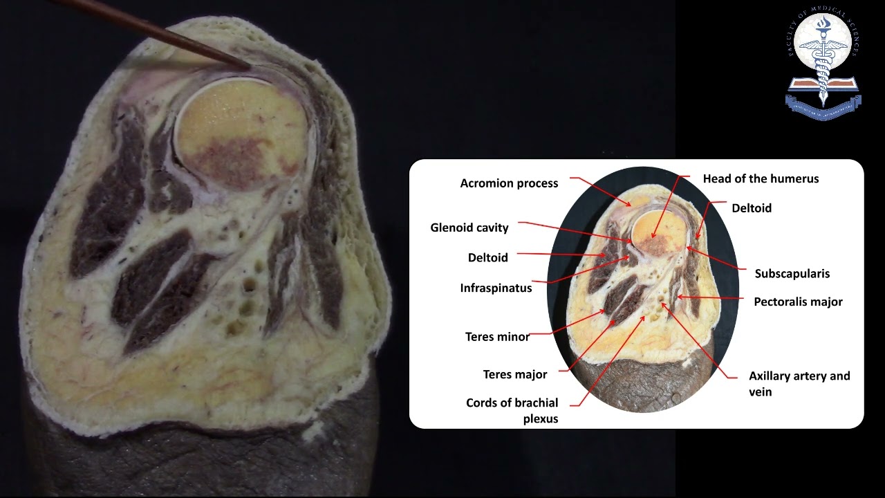 Upper Limb Sagittal Cross Section at the Axillary Region - Dr Sajith Edirisinghe