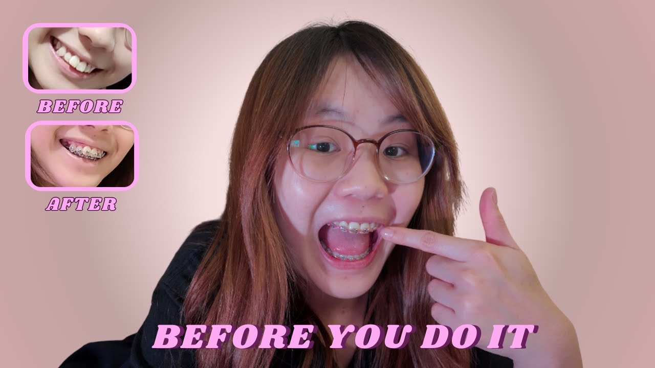 3 Things You MUST Know Before Getting Braces