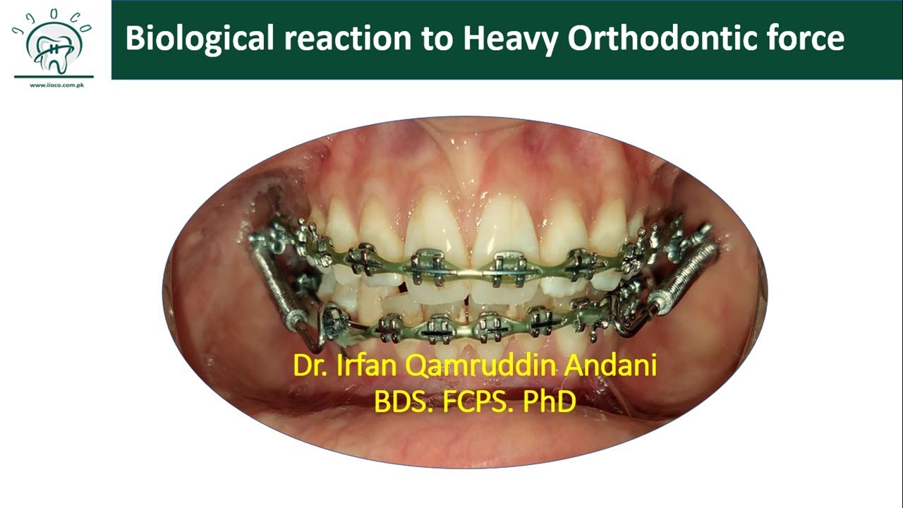 Biological Response of PDL to Heavy Orthodontic force