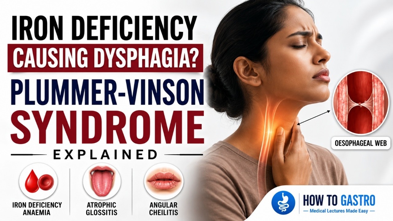 Plummer-Vinson Syndrome Explained | Why This Rare Condition Matters