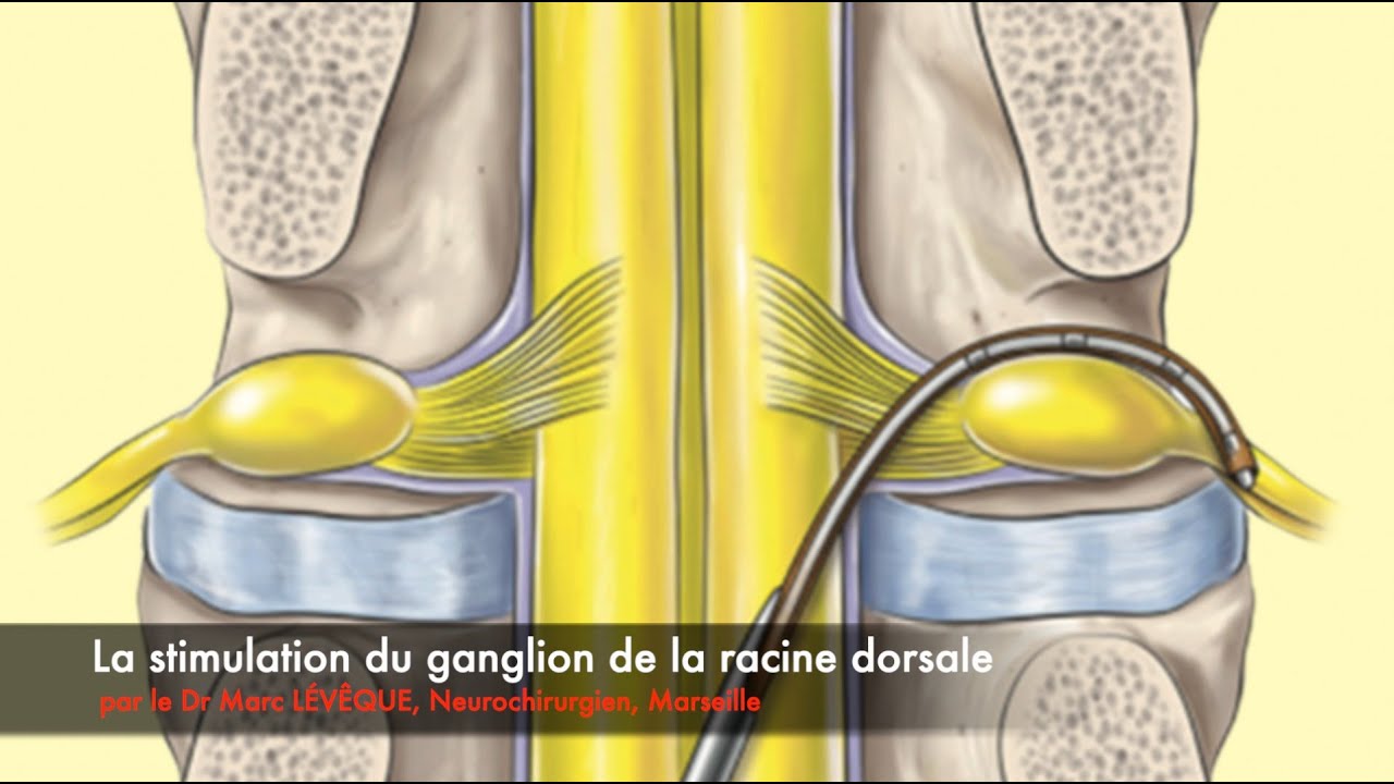 Stimulation du ganglion de la racine dorsale dans la douleur chronique