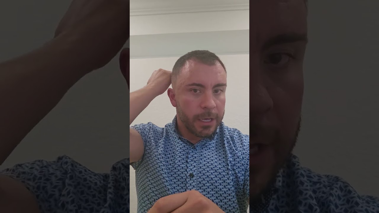 Month 1 Hair Transplant Update (Cosmedica- Istanbul, Turkey)