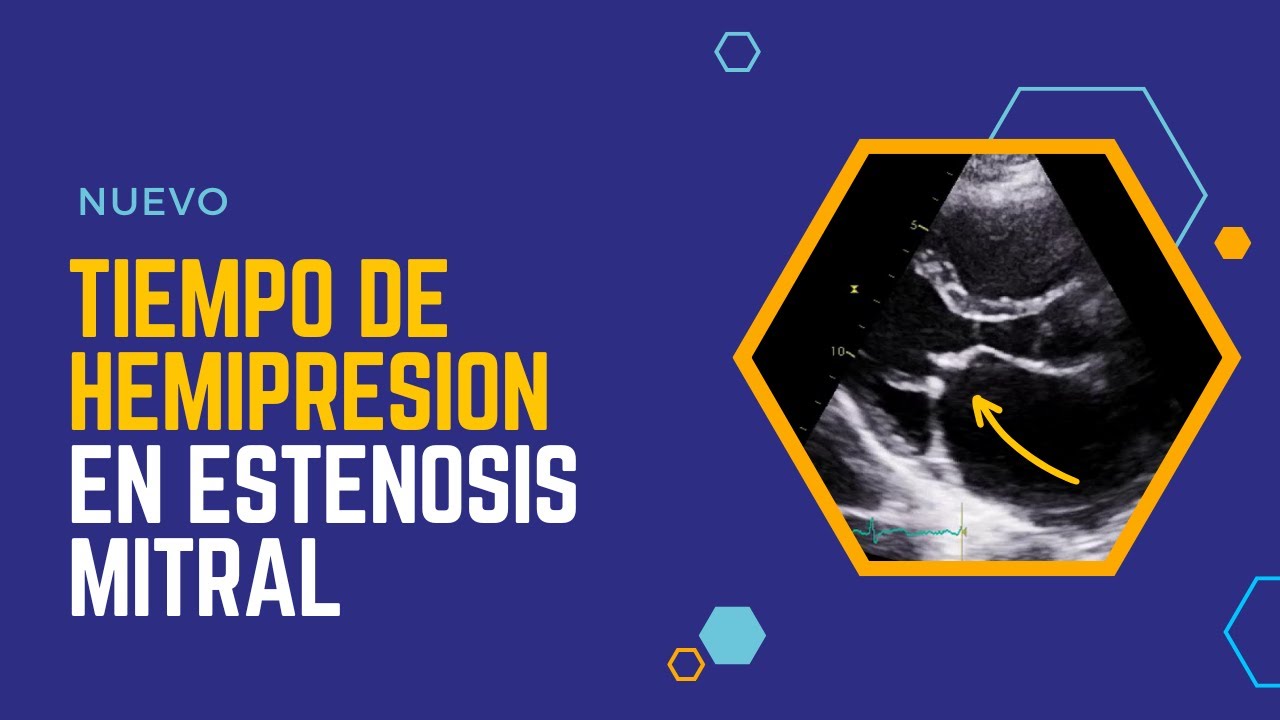 ⏰TIEMPO DE HEMIPRESION en ESTENOSIS MITRAL: ⚠️No te pierdas esto