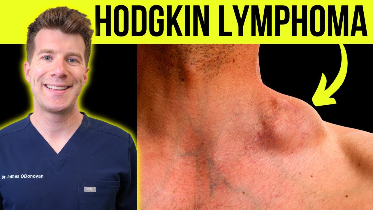 Doctor explains WARNING SYMPTOMS and SIGNS of HODGKIN'S LYMPHOMA CANCER