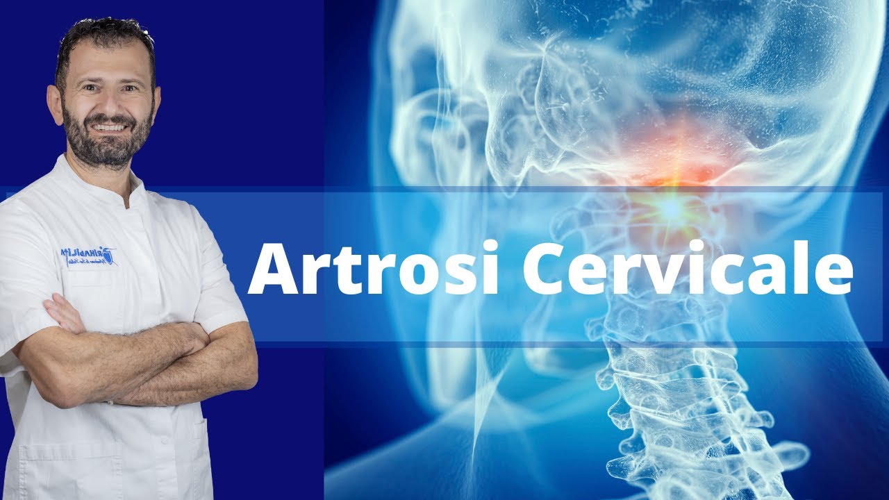 ARTROSI CERVICALE  SINTOMI, ESERCIZI E CURE EFFICACI