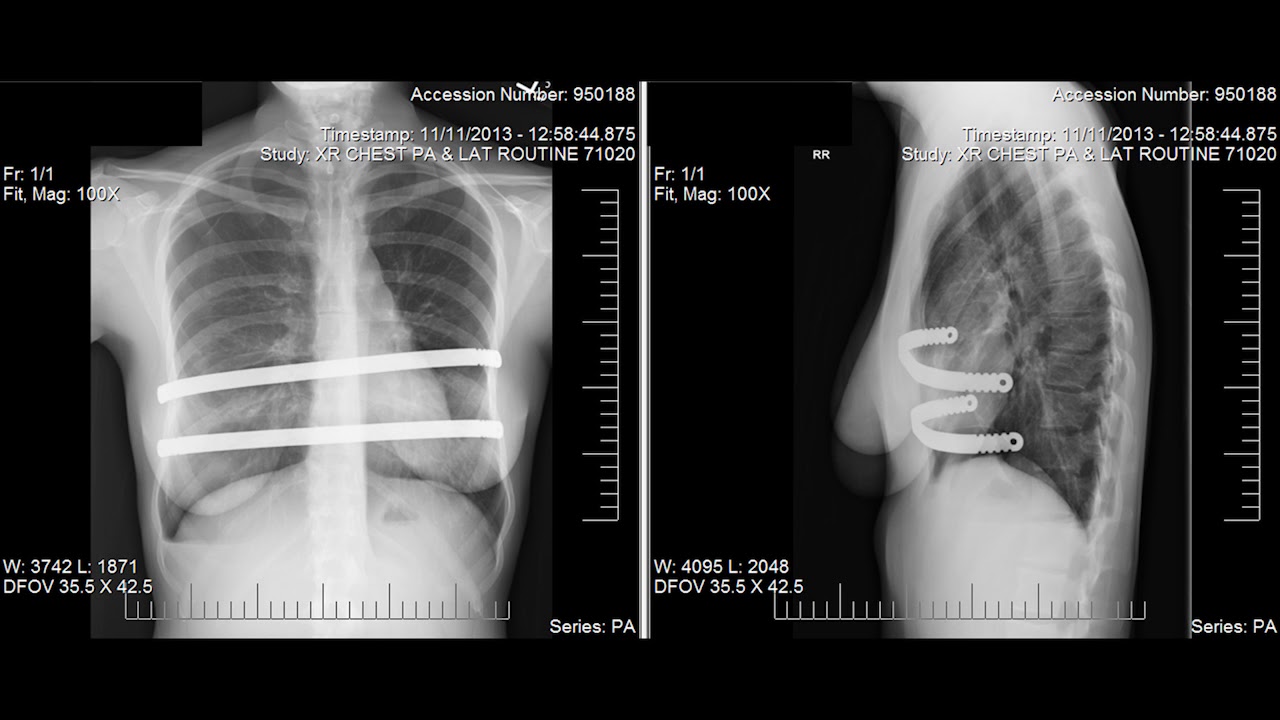 Recovery From Pectus Excavatum Repair
