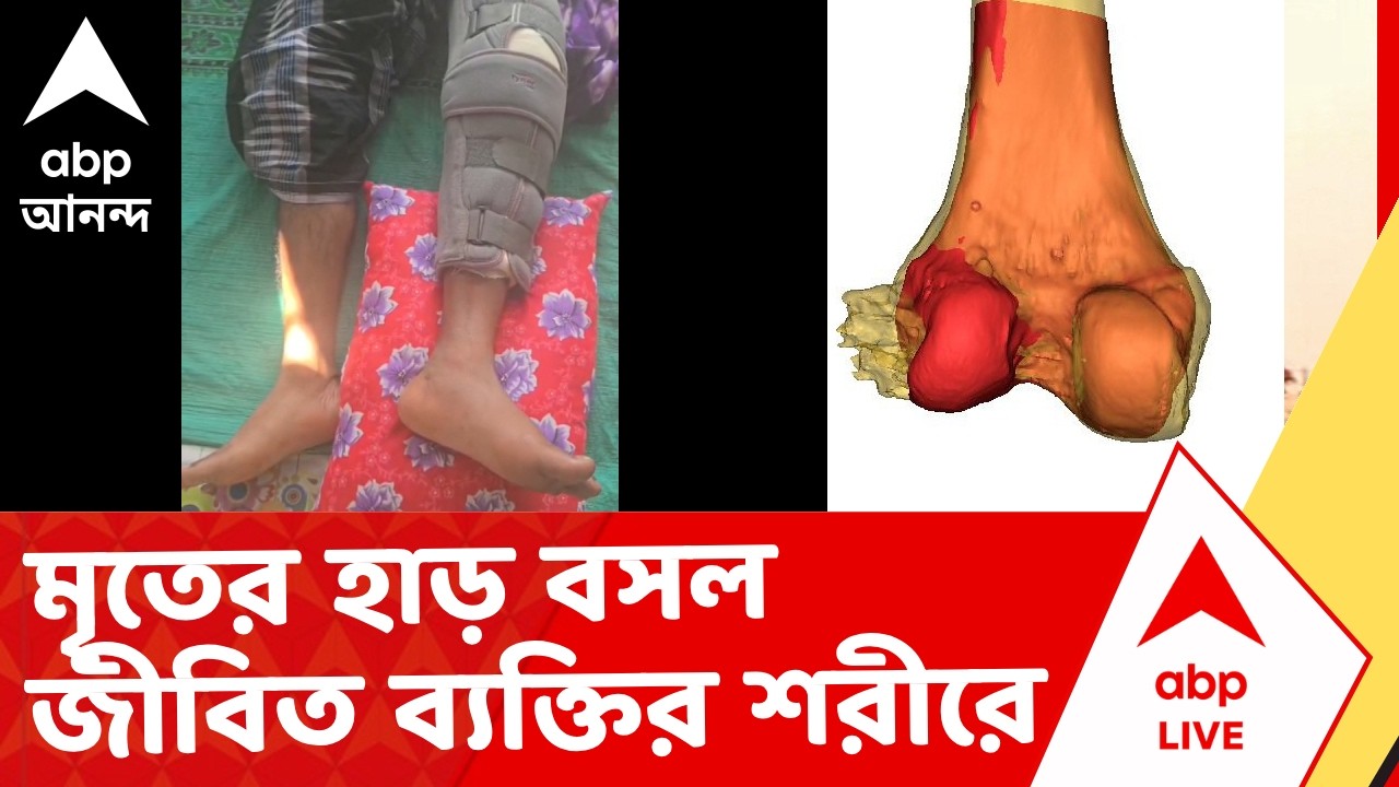 RG Kar News | রাজ্যে এই প্রথম মৃতের হাড় বসল জীবিত ব্যক্তির শরীরে I ABP Ananda Live