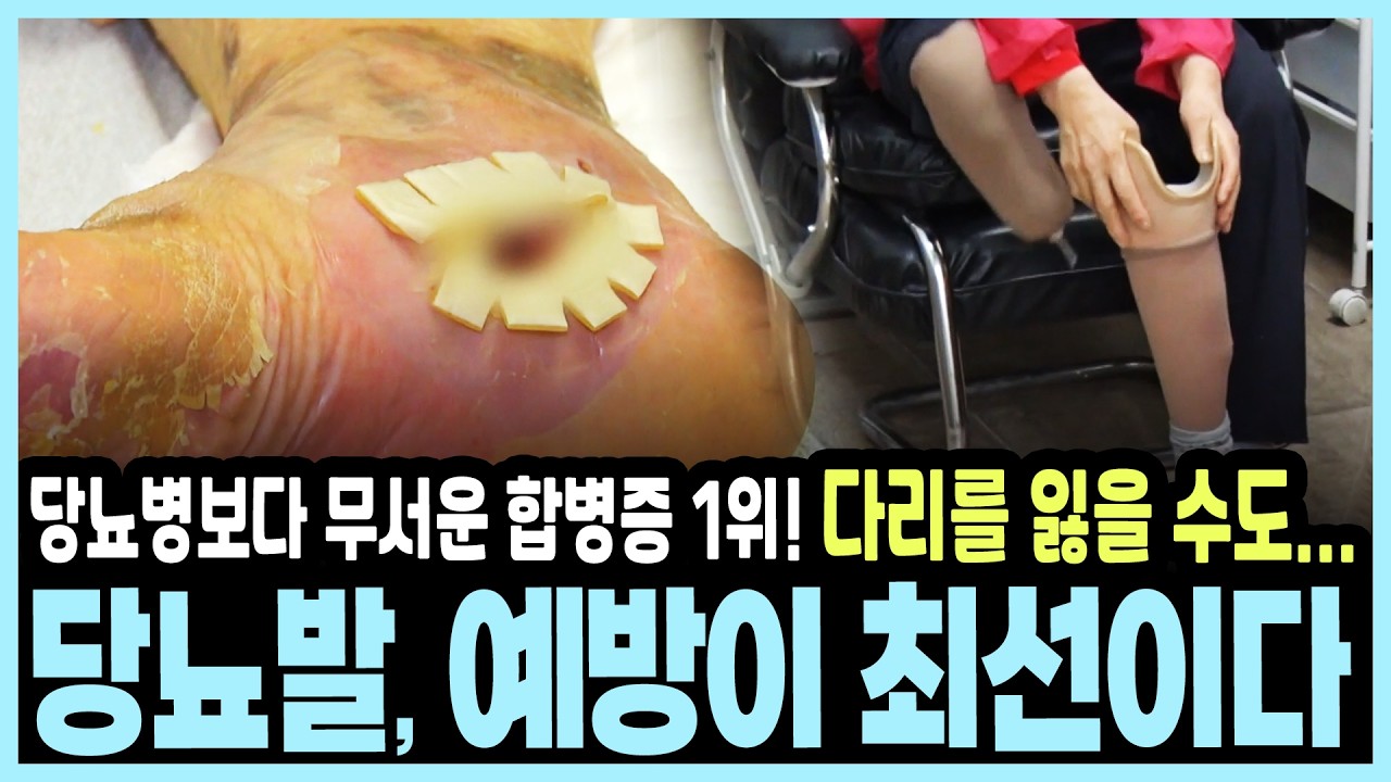 “작은 상처가 절단으로?” 당뇨 환자 4명 중 1명이 겪는 공포, '당뇨발'의 정체 I KBS 101세의 프러포즈 20170416 방송