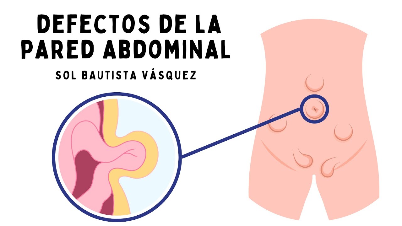 Defectos de la pared abdominal: clasificación y tratamiento de hernias