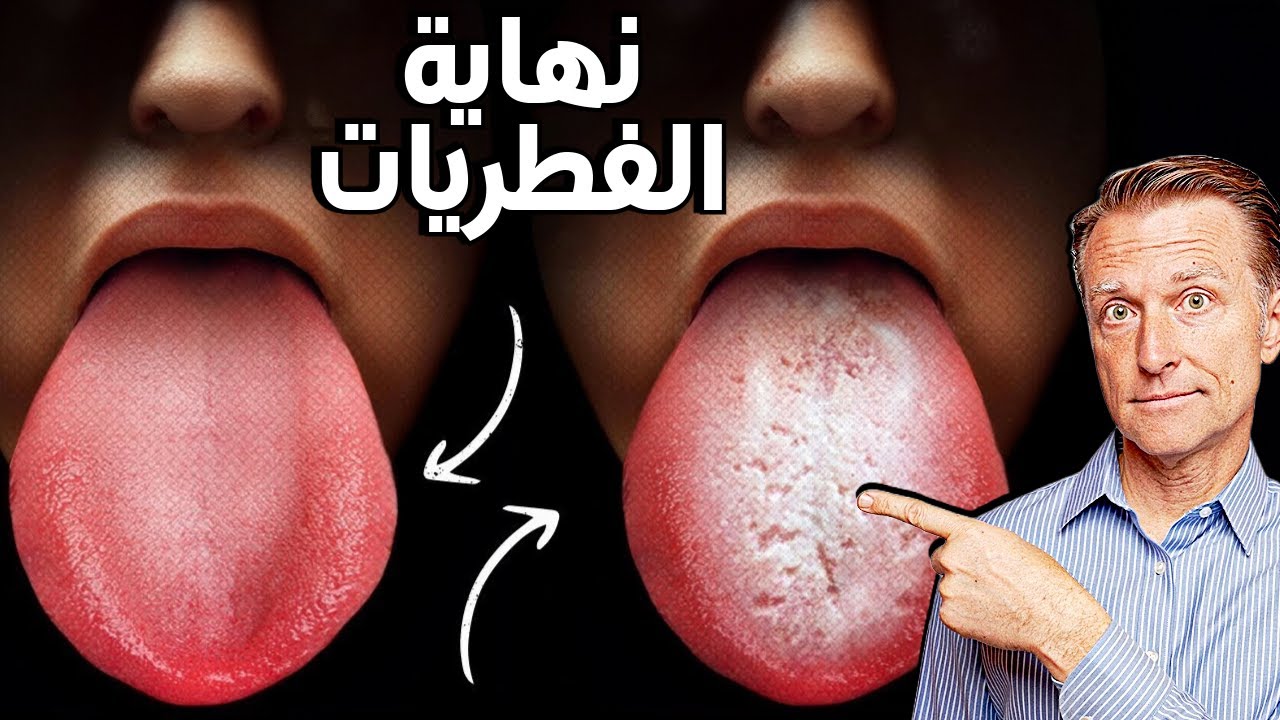 طريقة أفضل للتخلص من الكانديدا والفطريات