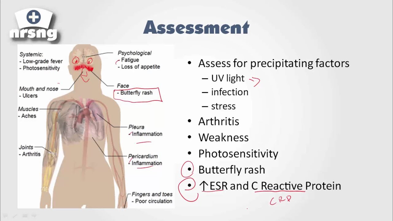 Lupus (SLE) NCLEX® Review | NRSNGacademy.com