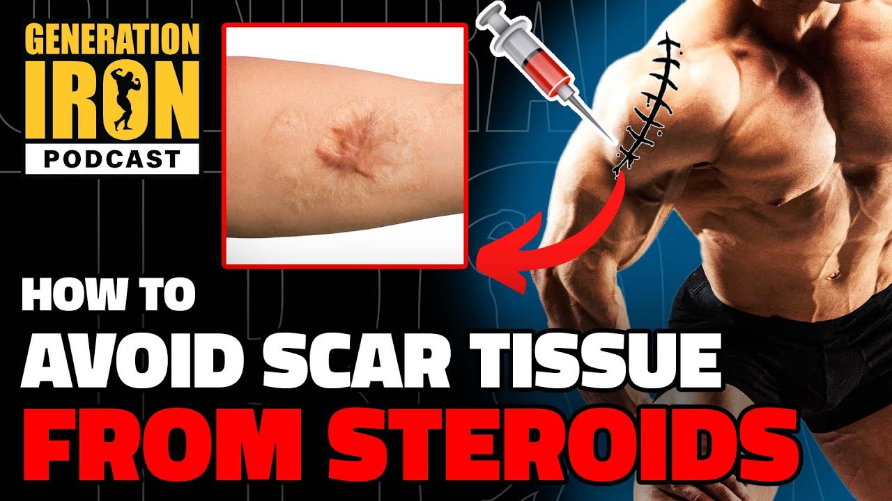 How To Avoid Scar Tissue From Steroid Injections In Bodybuilding | Generation Iron Podcast