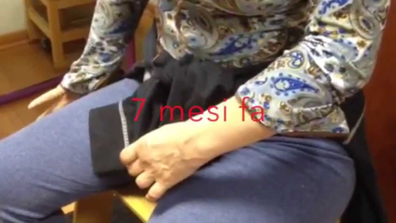 Recupero della mano Sig.ra I. dopo un Ictus