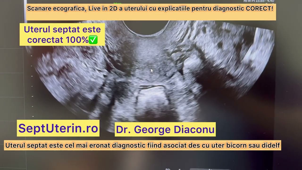 Uter sept (sept uterin)