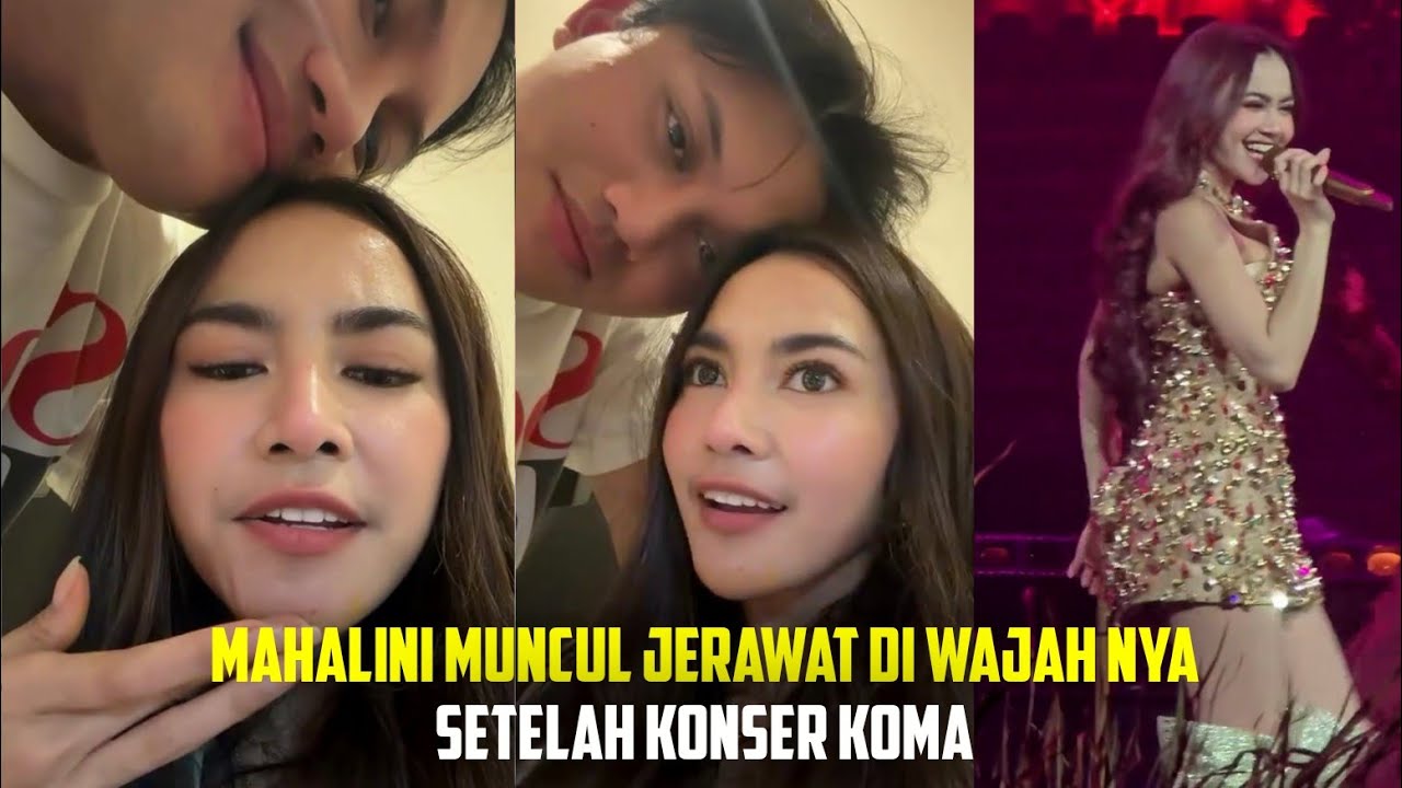 MAHALINI MUNCUL JERAWAT DI WAJAH NYA, SETELAH KONSER KOMA