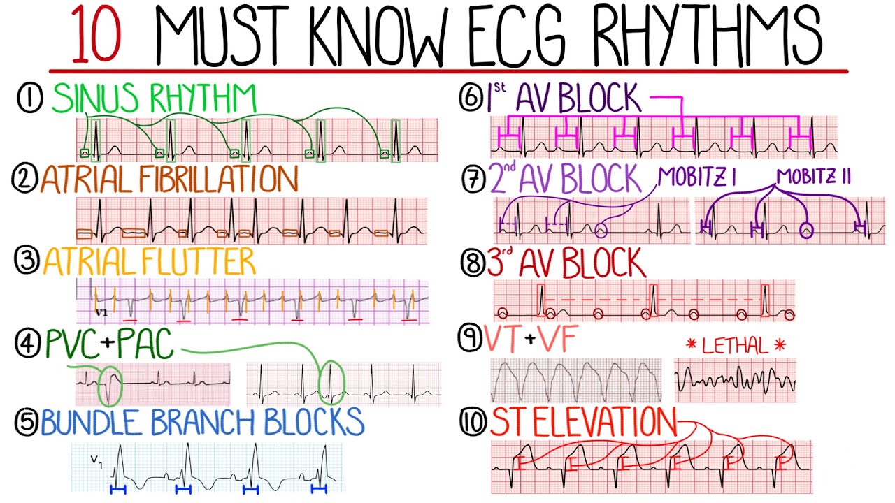 Most Common ECG Patterns You Should Know