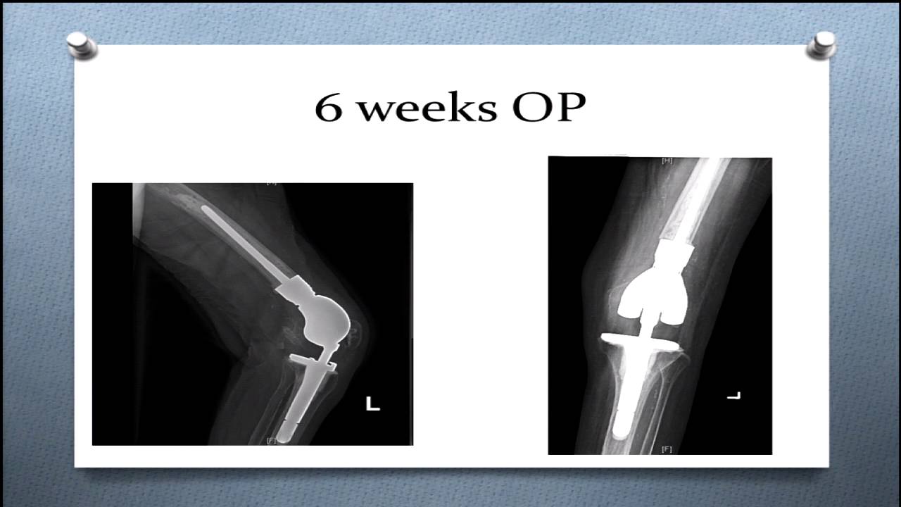 Periprosthetic femur fracture management: Panel discussion