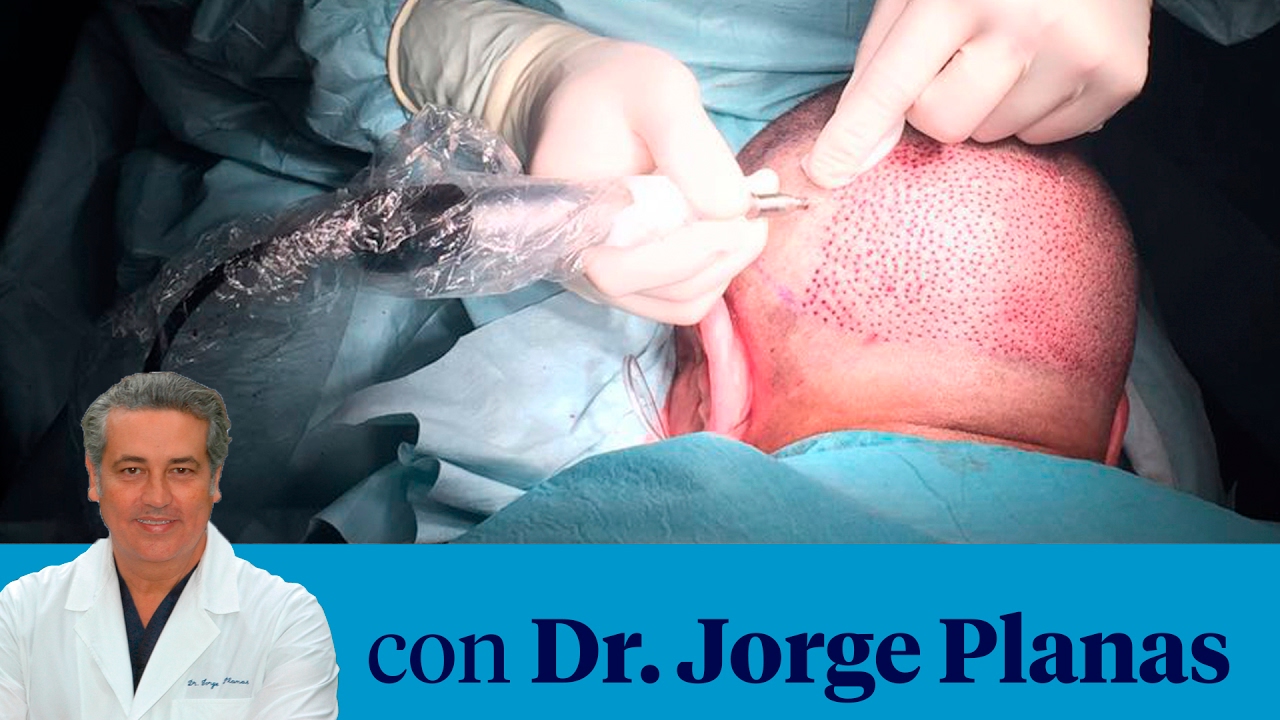 Transplante capilar con la técnica FUE
