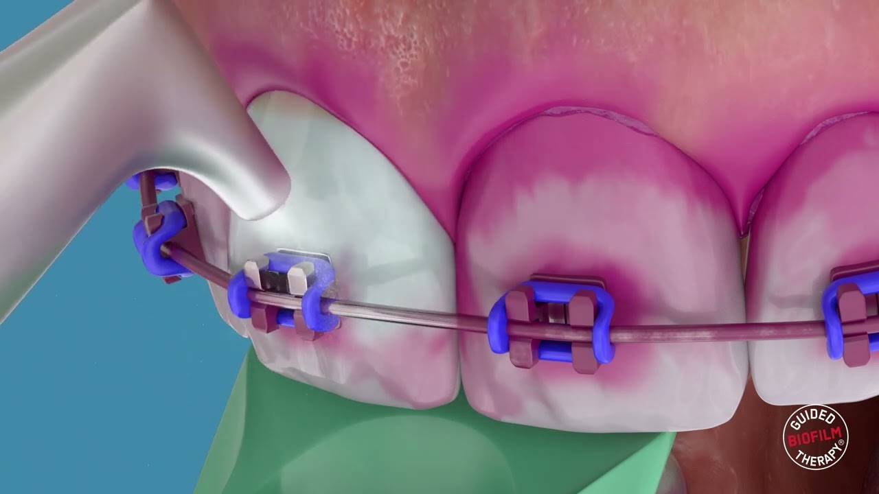 AIRFLOW MAX : élimination du biofilm, des colorations et du tartre récemment formé