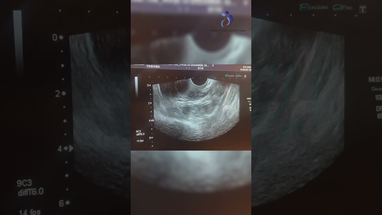 What is polycystic Ovary Syndrome