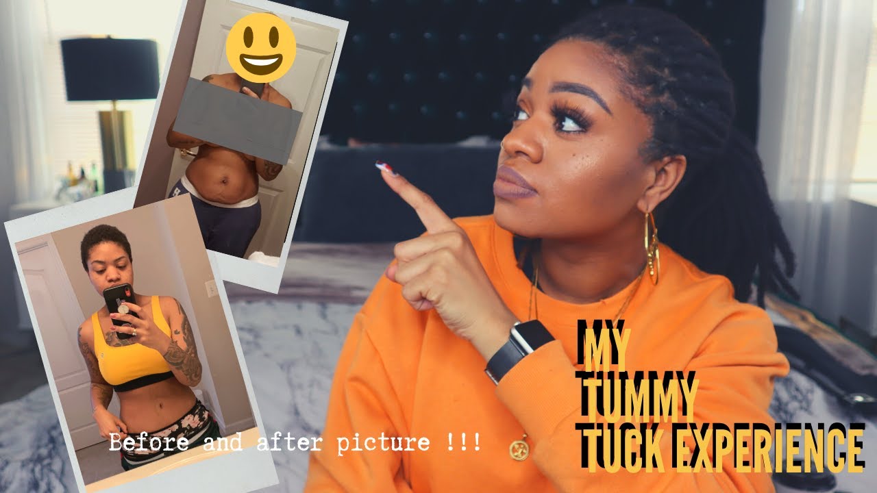 My Tummy Tuck Experience |  Before and After Picture | Alexis Nichole