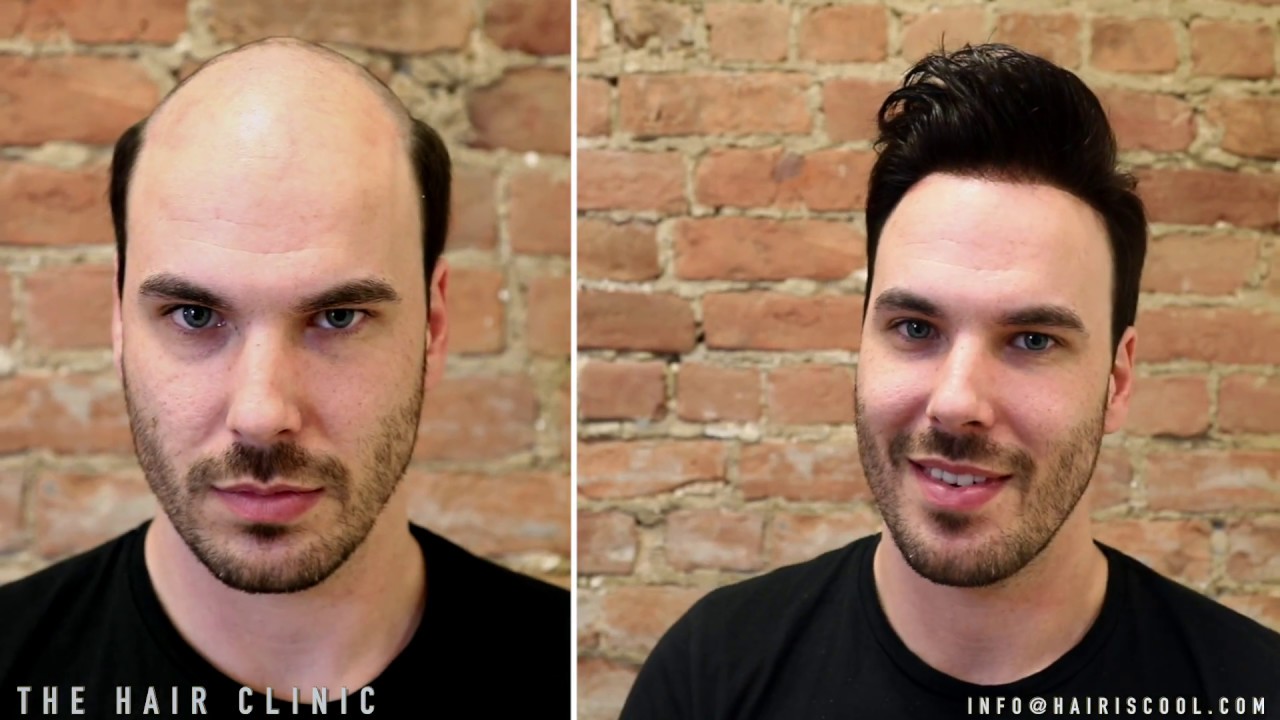 The Non Surgical Hair Graft - Hair Replacement at The Hair Clinic Montreal